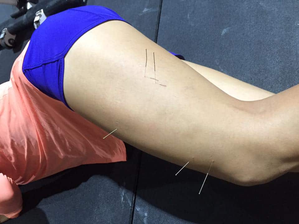 dry needling in singapore